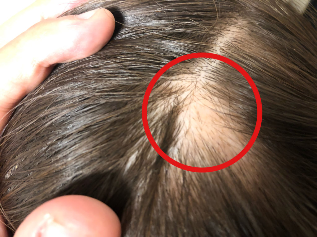 円形脱毛症の初期症状。チクチクした毛